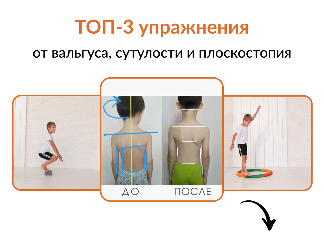 Плоскостопие и нарушение осанки предупреждение